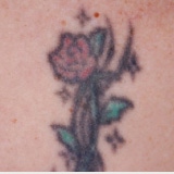 切開せずに刺青を除去したい