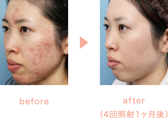 before/after（4回照射１ヶ月後）