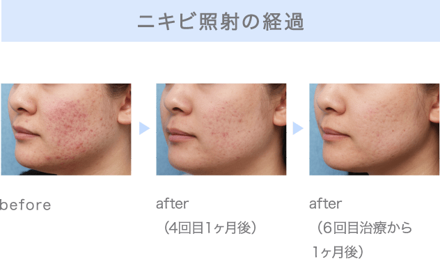 ニキビ照射の経過 before/after（4回目１ヶ月後）/after（６回目治療から１ヶ月後）