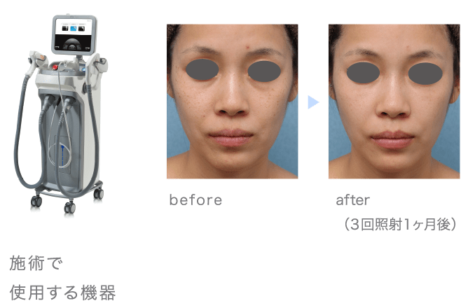 施術で使用する機器