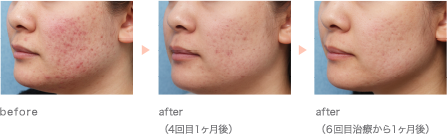 before/after(4回目1ヶ月後)/after(6回目治療から1ヶ月後)