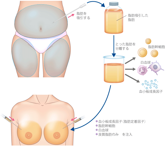脂肪を吸引する 脂肪吸引した脂肪 とった脂肪を分離する ・血小板成長因子(脂肪定着因子)・脂肪幹細胞・白血球・良質脂肪のみを注入