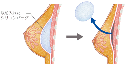 以前入れたシリコンバッグ