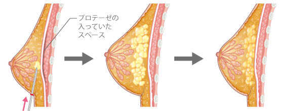 プロテーゼの入っていたスペース