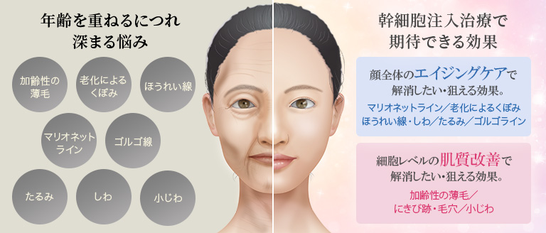 年齢を重ねるにつれ深まる悩み/幹細胞注入/点滴治療で期待できる効果