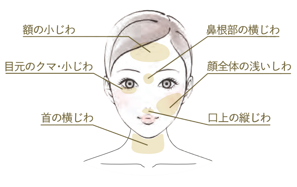 額の小じわ 鼻根部の横じわ 目元のクマ・小じわ 顔全体の浅いしわ 口上の縦じわ 首の横じわ