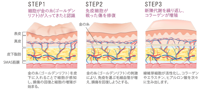 STEP1.細胞が金の糸(ゴールデンリフト)が入ってきたと認識「金の糸(ゴールデンリフト)を皮下に入れることで細胞が感知し、損傷の回復と細胞の増殖が始まる。」STEP2.免疫細胞が戦った傷を修復「金の糸(ゴールデンリフト)の刺激により、免疫を運ぶ毛細血管が増え、損傷を回復しようとする。」STEP3.新陳代謝を繰り返し、コラーゲンが増殖「線維芽細胞が活性化し、コラーゲンやエラスチン、ヒアルロン酸を次々に生み出します。」