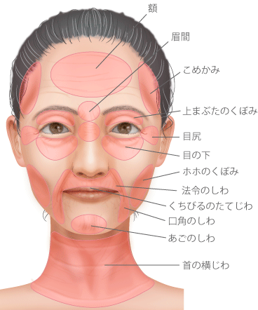 額 眉間 上まぶたのくぼみ 目尻 目の下 こめかみ法令のしわ ホホのくぼみ くちびるのたてじわ 口角のしわ あごのしわ