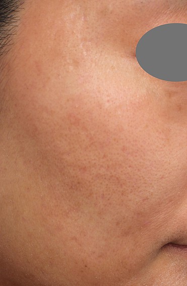 ヴァンパイアフェイシャルPRP治療後