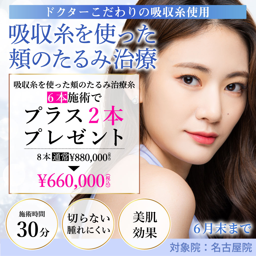 吸収糸を使った頬のたるみ治療 キャンペーン/6本施術で2本プレゼント 8本660,000円/名古屋院限定/6月末まで