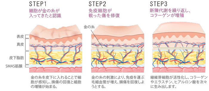 STEP1.細胞が金の糸が入ってきたと認識「金の糸を皮下に入れることで細胞が感知し、損傷の回復と細胞の増殖が始まる。」STEP2.免疫細胞が戦った傷を修復「金の糸の刺激により、免疫を運ぶ毛細血管が増え、損傷を回復しようとする。」STEP3.新陳代謝を繰り返し、コラーゲンが増殖「線維芽細胞が活性化し、コラーゲンやエラスチン、ヒアルロン酸を次々に生み出します。」