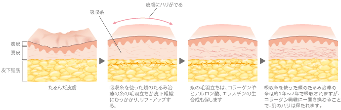たるんだ皮膚→吸収糸を使った頬のたるみ治療の糸の毛羽立ちが皮下組織にひっかかり、リフトアップする。→糸の毛羽立ちはコラーゲンやヒアルロン酸、エラスチンの生合成も促します→吸収糸を使った頬のたるみ治療の糸は約1年〜2年で吸収されますが、コラーゲン線維に置き換わることで、肌のハリは保たれます。