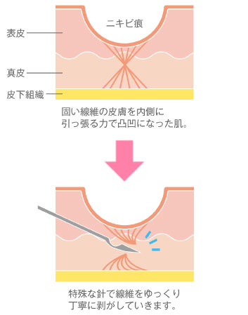 サブシジョン＋ジュベルック治療