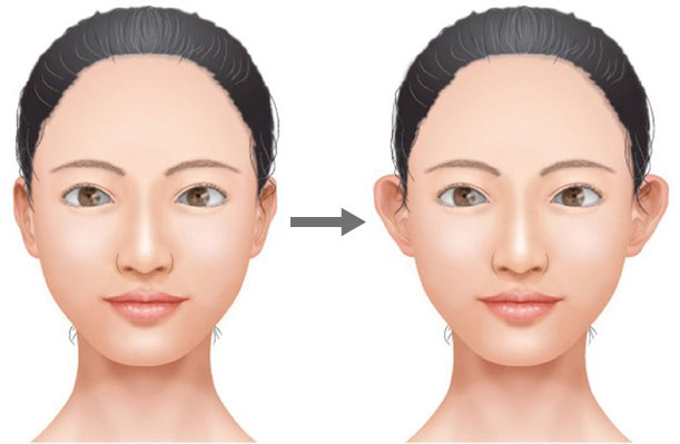 立ち耳にする手術とは