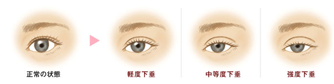 眼瞼下垂の重症度分類
