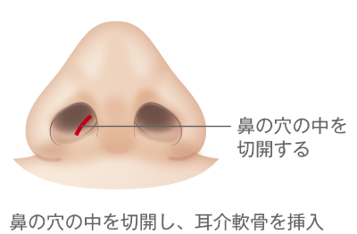 Cカール4