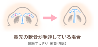 鼻先の軟骨が発達している場合 鼻筋すっきり(軟骨切除)