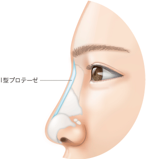 当院で使用しているI型プロテーゼ　皮膚に負担がかからない。ブタ鼻になりにくい。笑ったときに鼻先が自然にあがる。