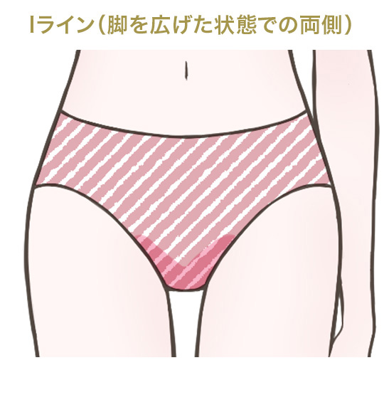 Iライン(脚を広げた状態での両側)