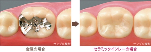 金属の場合 セラミックインレーの場合