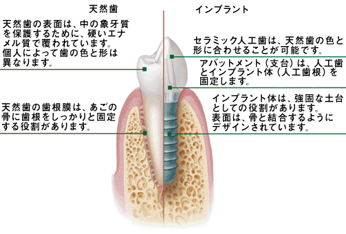 天然歯:天然歯の表面は、中の象牙質を保護するために、硬いエナメル質で覆われています。個人によって歯の色と形は異なります。 天然歯の歯根膜は、あごの骨に歯根をしっかりと固定する役割があります。 インプラント:セラミック人工歯は、天然歯の色と形に合わせることが可能です。 アバットメント(支台)は、人工歯とインプラント体(人工歯根)を固定します。 インプラント体は、強固な土台としての役割があります。表面は、骨と結合するようにデザインされています。