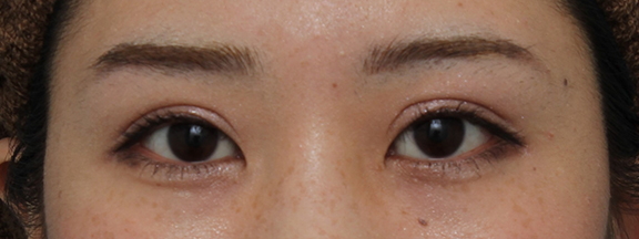 症例写真,元々幅の狭い二重の20代女性に全切開二重術を行い、幅広の平行二重にした症例写真,After(6ヶ月後のメイクあり),