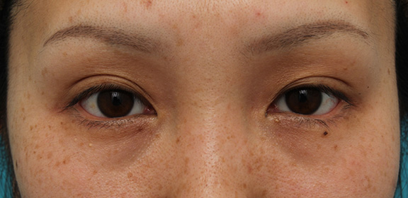 症例写真,30代女性に目尻切開・垂れ目形成を行い、目を一回り大きくした症例写真,After(6ヶ月後),ba_mejiri019_b02.jpg