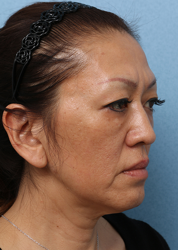 Vシェイプリフト(ヒアルロン酸注射),Vシェイプリフト(ヒアルロン酸注射) 50代女性の症例写真,After(3ヶ月後),ba_v_shapelift013_b02.jpg