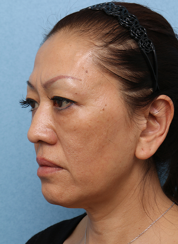 Vシェイプリフト(ヒアルロン酸注射),Vシェイプリフト(ヒアルロン酸注射) 50代女性の症例写真,After(3ヶ月後),ba_v_shapelift013_b04.jpg