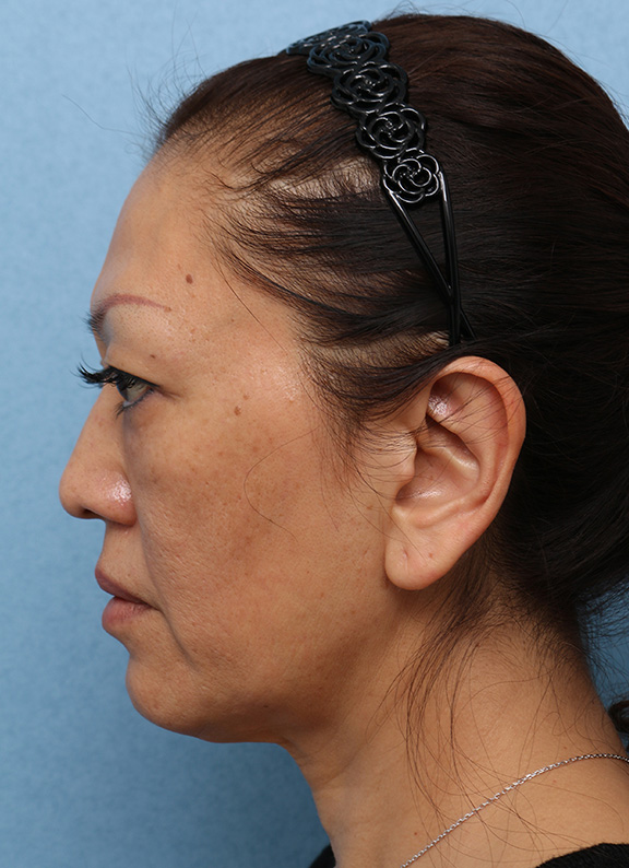 Vシェイプリフト(ヒアルロン酸注射),Vシェイプリフト(ヒアルロン酸注射) 50代女性の症例写真,After(3ヶ月後),ba_v_shapelift013_b05.jpg