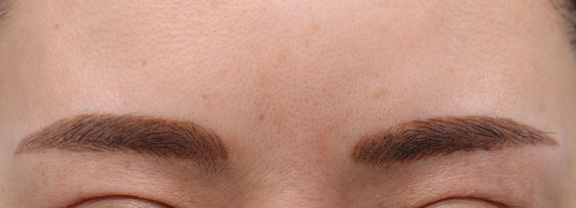 眉間のシワ取りボツリヌストキシン注射の症例写真,After（1ヶ月後）,ba_botox015_a01.jpg