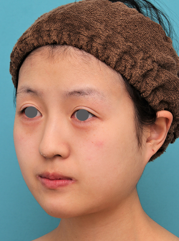 あご形成(シリコンプロテーゼ),20代女性の顎のシリコンプロテーゼの症例写真,After(6ヶ月後),ba_ago019_b02.jpg
