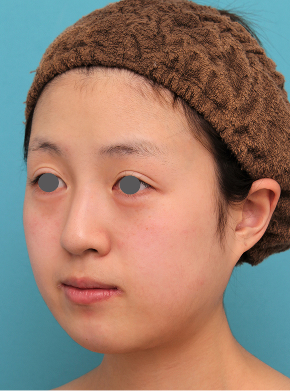 あご形成(シリコンプロテーゼ),20代女性の顎のシリコンプロテーゼの症例写真,Before,ba_ago019_b02.jpg
