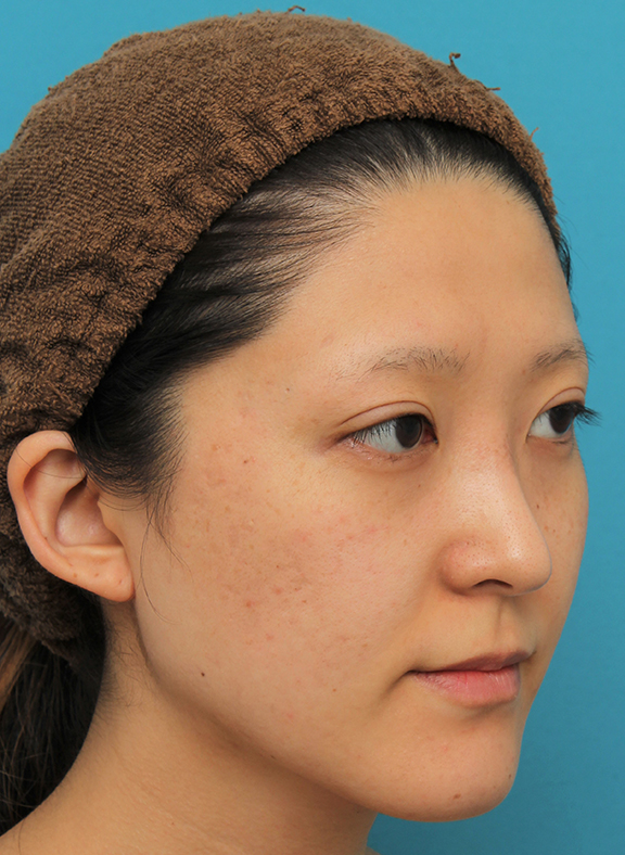 症例写真,ハンプ切除+鼻骨切り幅寄せでワシ鼻を真っ直ぐにし、鼻筋を通した症例写真,After(6ヶ月後),ba_hump012_b02.jpg