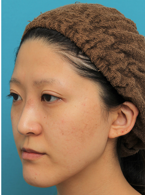 症例写真,ハンプ切除+鼻骨切り幅寄せでワシ鼻を真っ直ぐにし、鼻筋を通した症例写真,After(6ヶ月後),ba_hump012_b04.jpg