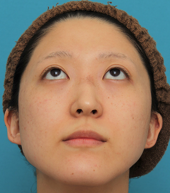 症例写真,ハンプ切除+鼻骨切り幅寄せでワシ鼻を真っ直ぐにし、鼻筋を通した症例写真,After(6ヶ月後),ba_hump012_b06.jpg