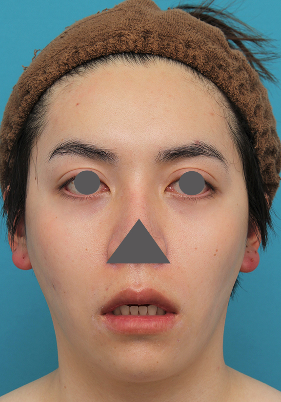 症例写真,上下の厚い唇を手術で薄くした男性の症例写真,After(6ヶ月後),ba_usuku013_b02.jpg