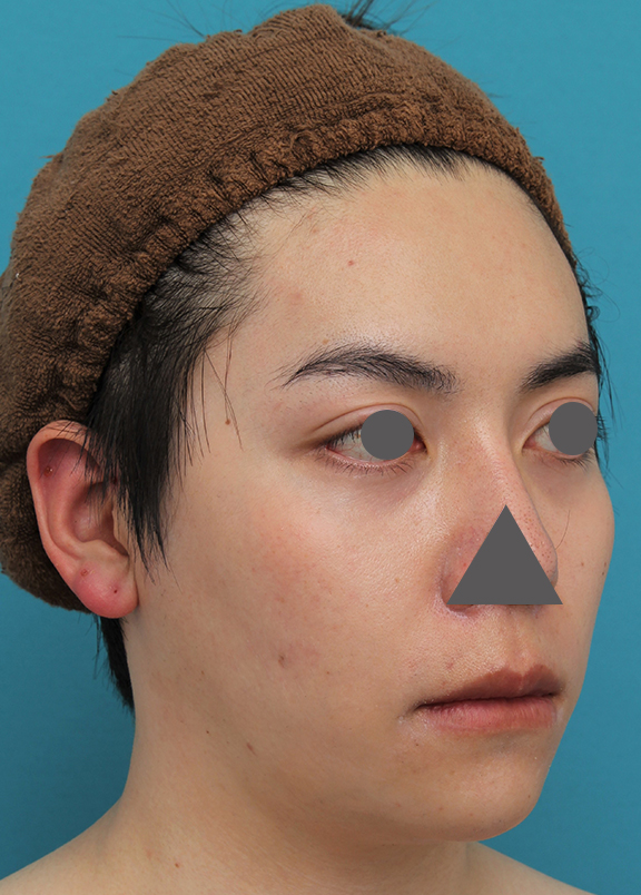 症例写真,上下の厚い唇を手術で薄くした男性の症例写真,After(6ヶ月後),ba_usuku013_b03.jpg
