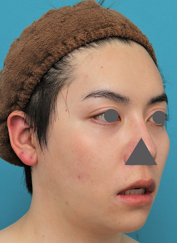 症例写真,上下の厚い唇を手術で薄くした男性の症例写真,After(6ヶ月後),ba_usuku013_b04.jpg