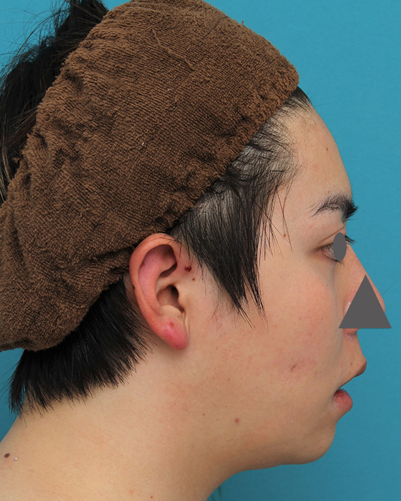 症例写真,上下の厚い唇を手術で薄くした男性の症例写真,After(6ヶ月後),ba_usuku013_b06.jpg