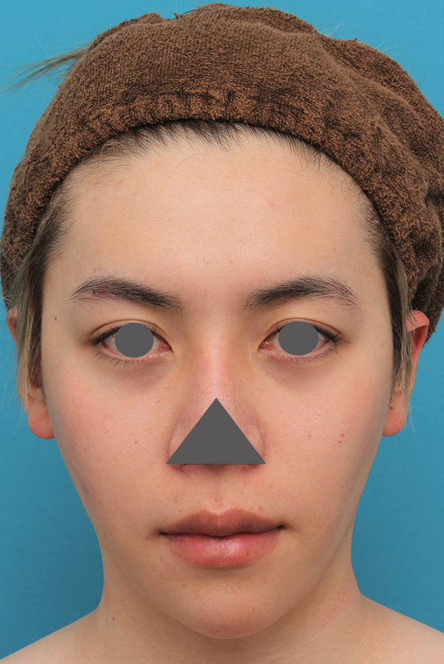 症例写真,上下の厚い唇を手術で薄くした男性の症例写真,手術前,口を閉じた状態,mainpic_usuku013a.jpg