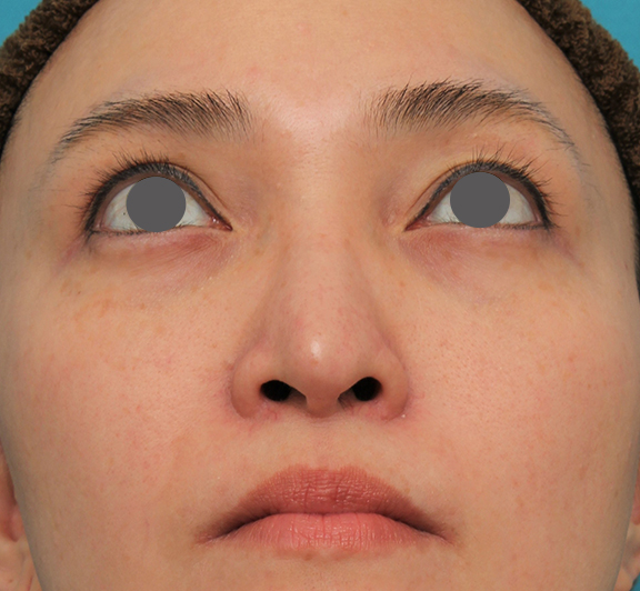 症例写真,魔女鼻に対して垂れ鼻修正手術と小鼻縮小手術を同時に行った症例写真,After(6ヶ月後),ba_tarebana001_b04.jpg
