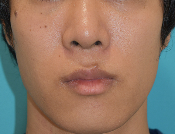 症例写真,鼻尖形成の症例写真,After(1ヶ月後),ba_bisen028_b01.jpg