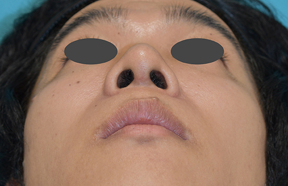 症例写真,鼻尖形成の症例写真,After(1ヶ月後),ba_bisen028_b03.jpg