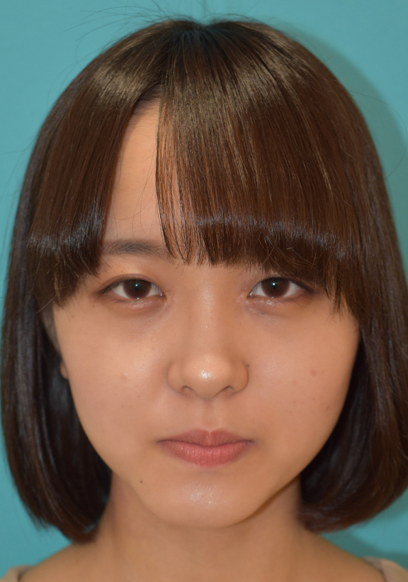症例写真,目頭切開の症例 目の間隔が広い事を気にされていた全顔モニターの女性,After(メイクあり),