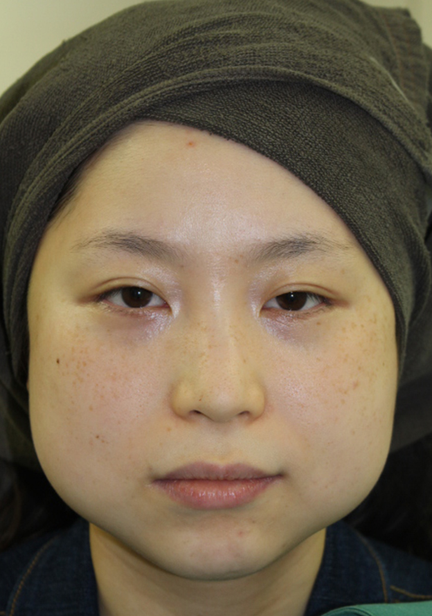 症例写真,バッカルファットの除去の症例写真,手術直後,mainpic_buccalfat019b.jpg