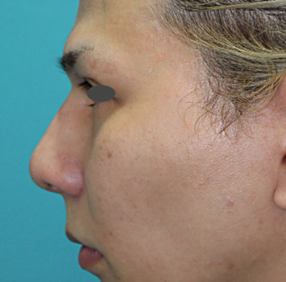 症例写真,ハンプ骨切り+隆鼻プロテーゼ+耳介軟骨移植の症例写真,After(1年後),ba_hump013_b02.jpg