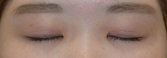 症例写真,二重まぶた・全切開法の症例 一重瞼から二重瞼になった女性,After(1ヶ月後)<br/>
(目を閉じた状態),
