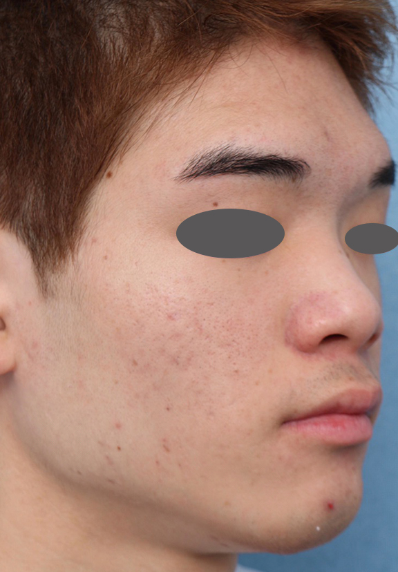 症例写真,ニキビ治療の症例写真 おでこ、両頬に赤いニキビが散在している男性,After(6ヶ月後),ba_ipl008_b02.jpg