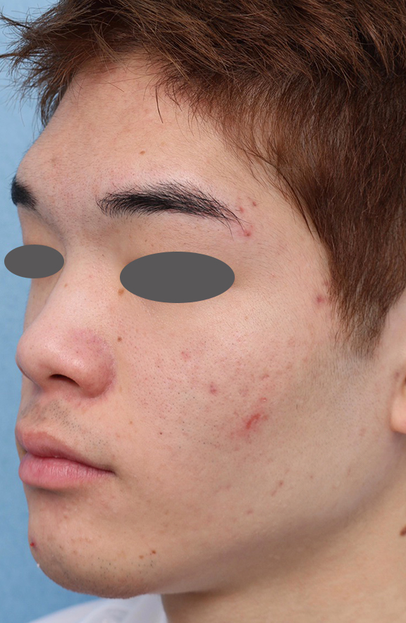 症例写真,ニキビ治療の症例写真 おでこ、両頬に赤いニキビが散在している男性,After(6ヶ月後),ba_ipl008_b03.jpg